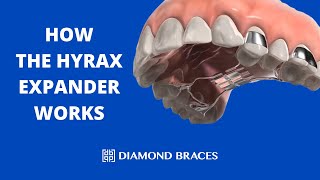 How The Hyrax Expander Works [upl. by Asiram]