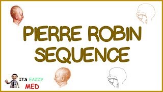 Pierre Robin Sequence PRS [upl. by Dorine]