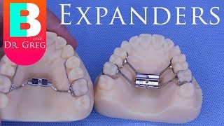 BRACES EXPLAINED Palatal Expanders [upl. by Aneeuqahs400]