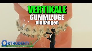 Gummizüge vertikal festsitzende Zahnspange Kieferorthopädie  Orthodentix [upl. by Ennaillij902]