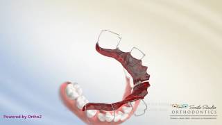 Schwartz Appliance  Lower Expander  Orthodontic Treatment [upl. by Carlyle]