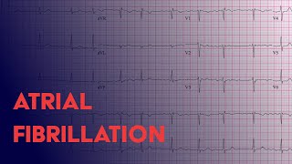 Atrial Fibrillation Afib  EKG ECG Interpretation [upl. by Irtimd]