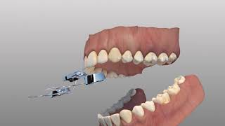 Rapid Palatal Expander [upl. by Nordgren873]