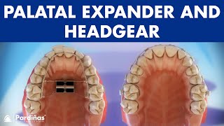 Orthodontic devices  Palatal expander and headgear © [upl. by Aradnahc]